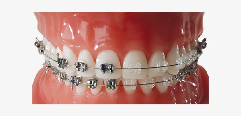 Brackets-blancoss - Brackets Invisibles, transparent png