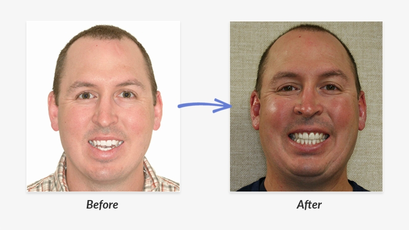 Before And After Braces Photo - Before Braces, transparent png