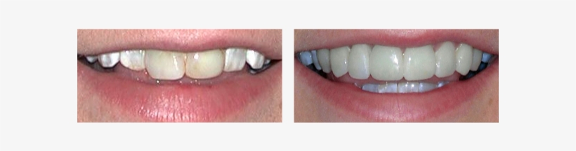 Before And After Teeth Whiting Treatment Case - Veneer, transparent png
