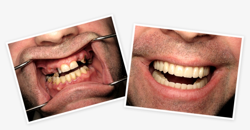Find Out How To Replace Missing Teeth Without A Denture, - Tongue, transparent png