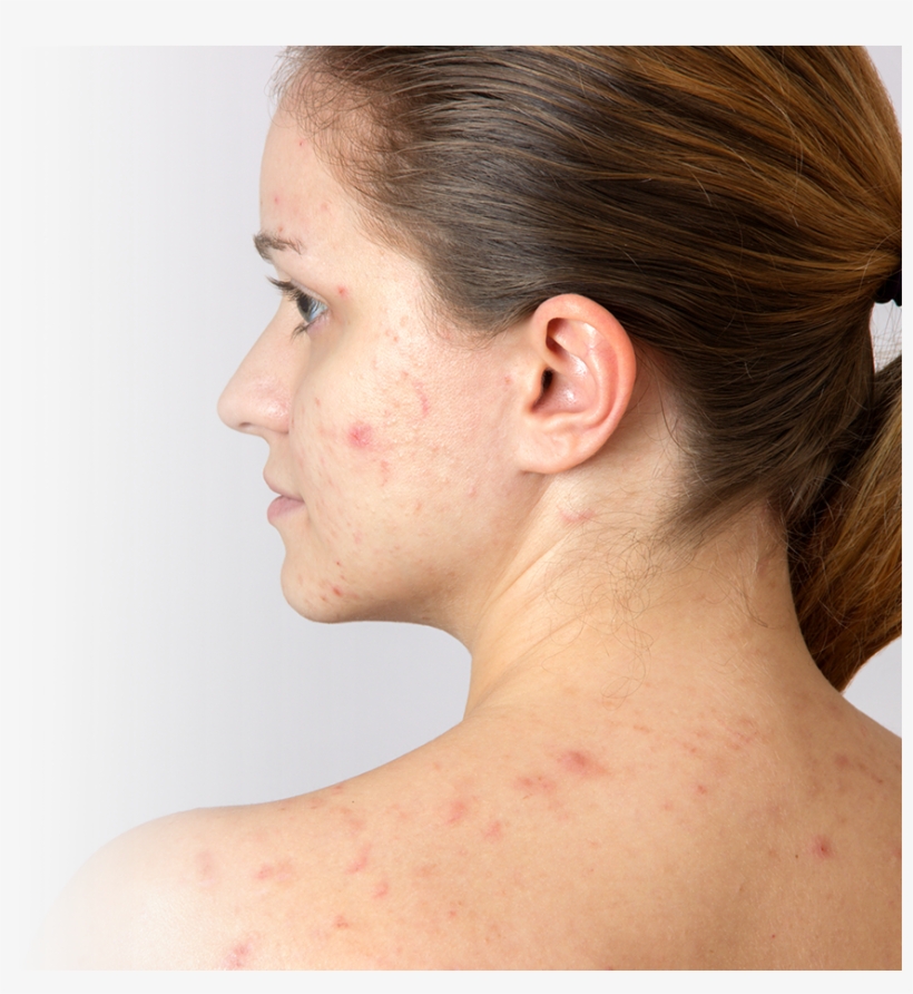 6 Solutions To Get Rid Of Adult Acne - Pregnancy Acne, transparent png
