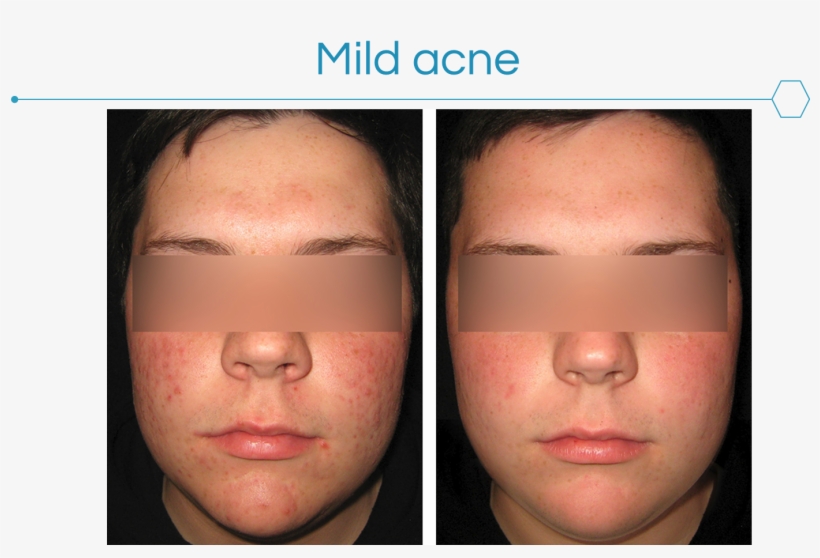 Acne Can Be Very Frustrating To The Patient And Have - Myers Dermatology, transparent png