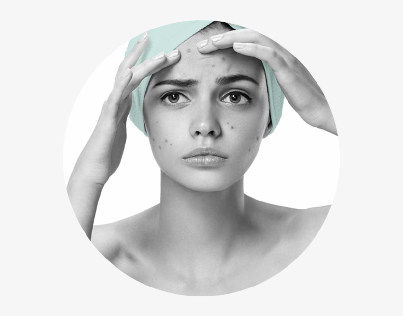 Noticia Anterior Acne Y Cicatrices Corporal Siguiente - Acne En Adolescentes, transparent png