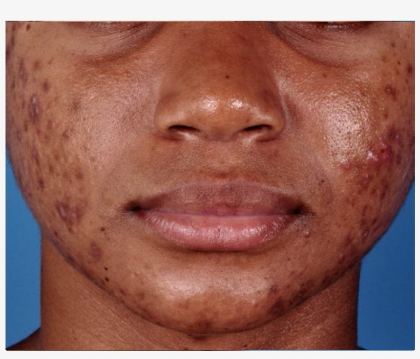 Zo® Oil Control Pads Acne Treatment Before Zo Medical Before And After 1200x1200 PNG