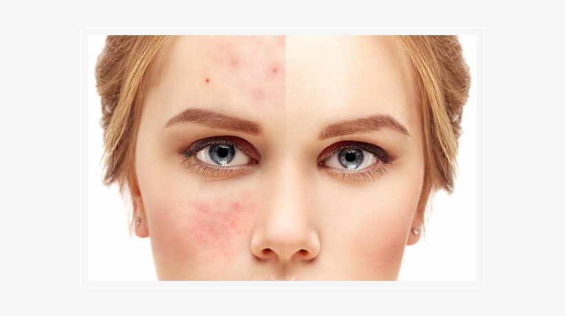 Acne Treatment - Gerötete Gesichtshaut, transparent png