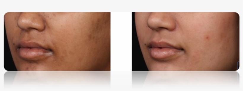 Acne - Plastic Surgery, transparent png