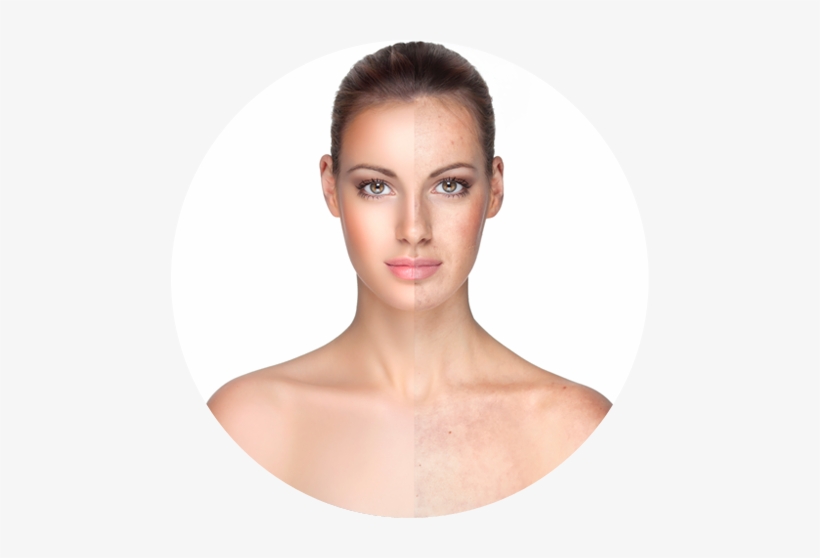 Freckles Are Also Known As Ephelis And Appear As Small - Martiderm Dsp Cover Stick Fps50 Set 2 Pieces, transparent png