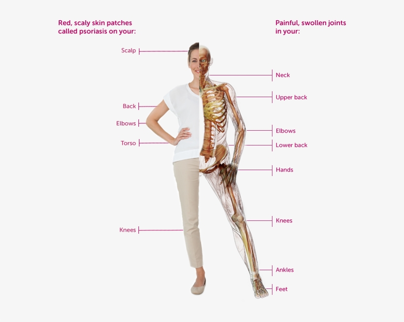 Some People Have Psoriasis Symptoms For 10 Years Before - Psoriatic Arthritis Pain, transparent png