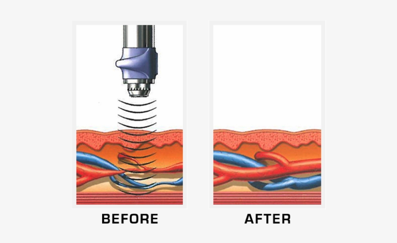 Peyronie's Disease Treatment, transparent png