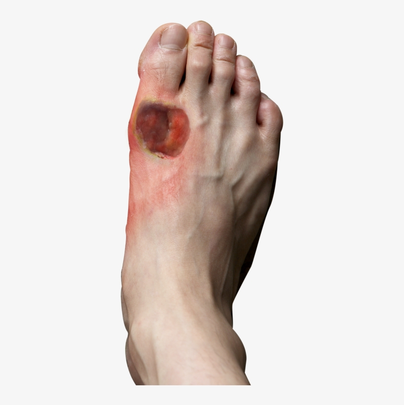 Signs And Symptoms Of Diabetic Foot - Diabetes Foot, transparent png