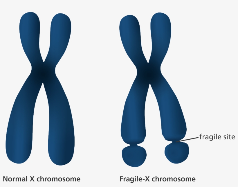 An Illustration Showing The Appearance Of Normal And - Fragile X Syndrome Diagram, transparent png