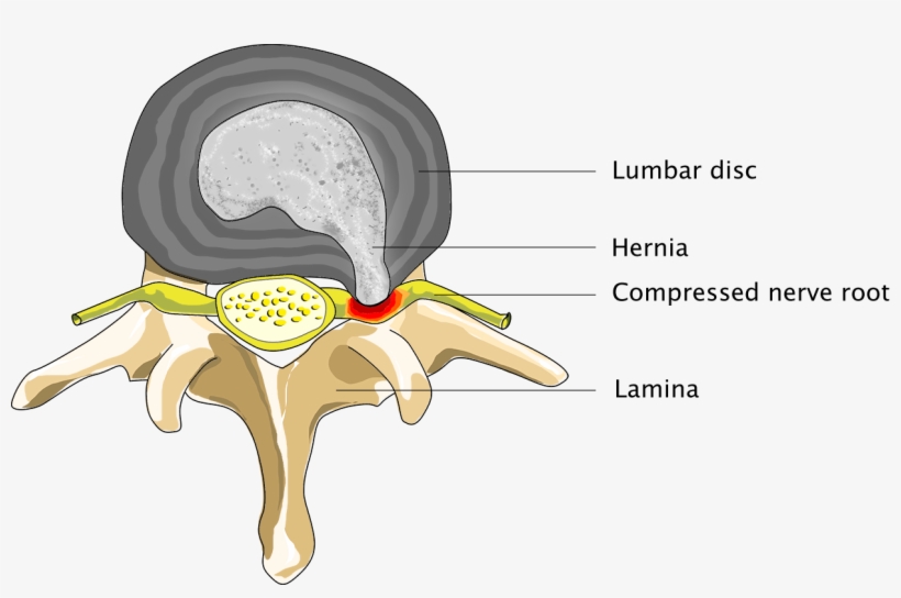 Patient Suffering From Spinal Hernia - Spinal Hernia, transparent png