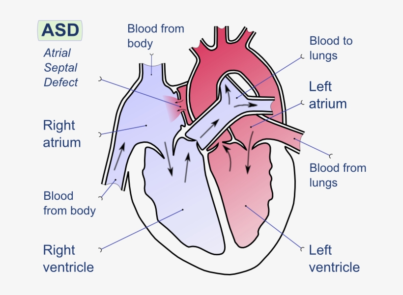Hypoplastic Left Heart Syndrome - Atrial Septal Defect, transparent png