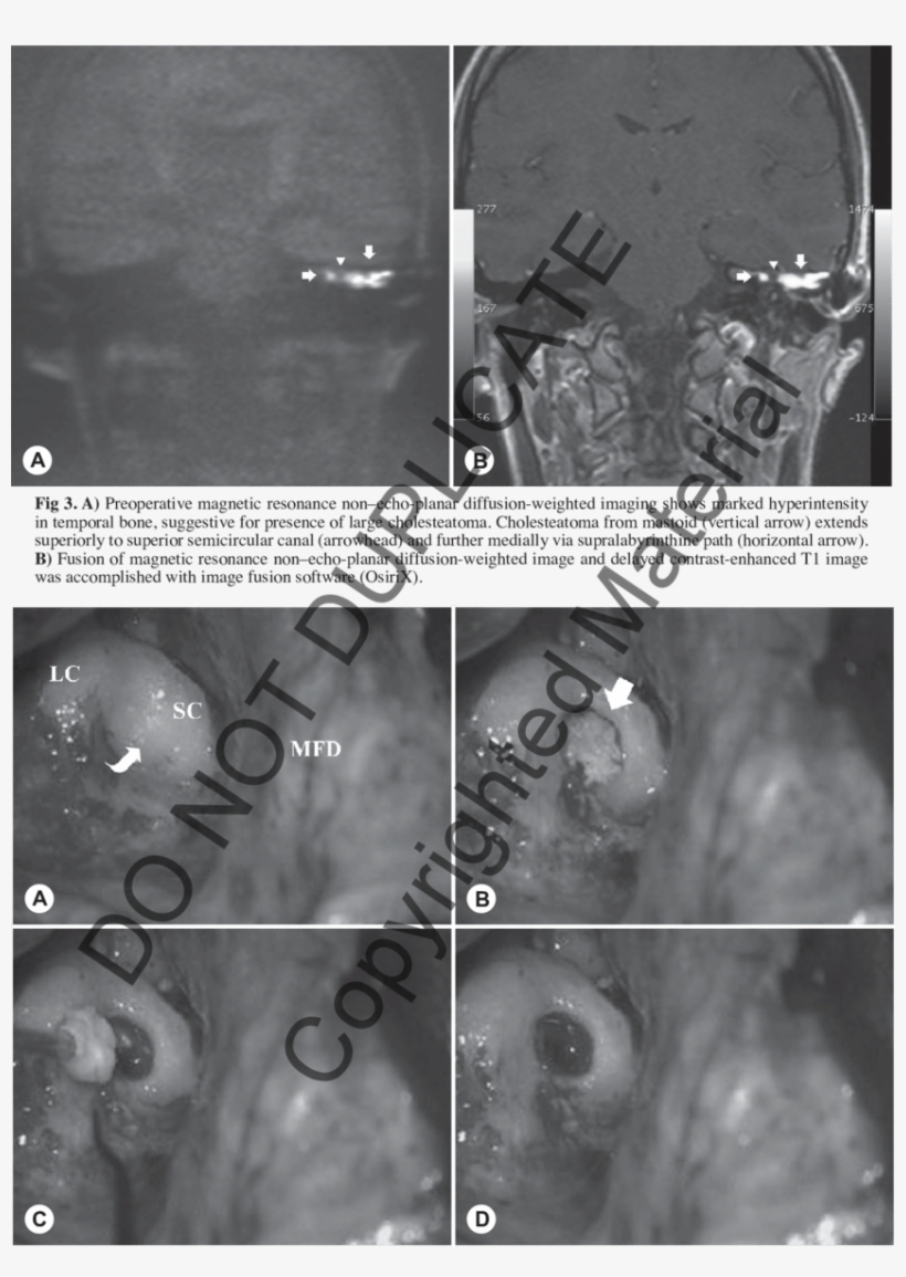 A) View Prior To Opening Subarcuate Cell Tract (arrow - Subarcuate Fossa, transparent png