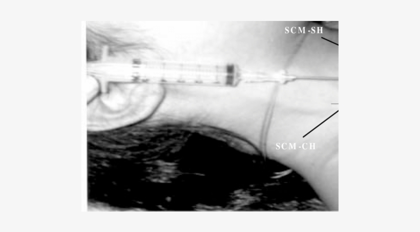 Anatomic Landmarks For The Pocket Approach And The - Monochrome, transparent png