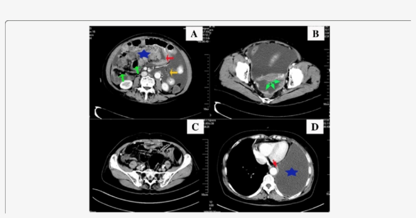 A Intravenous And Oral Contrast-enhanced Ct Scan Shows - Stomach, transparent png