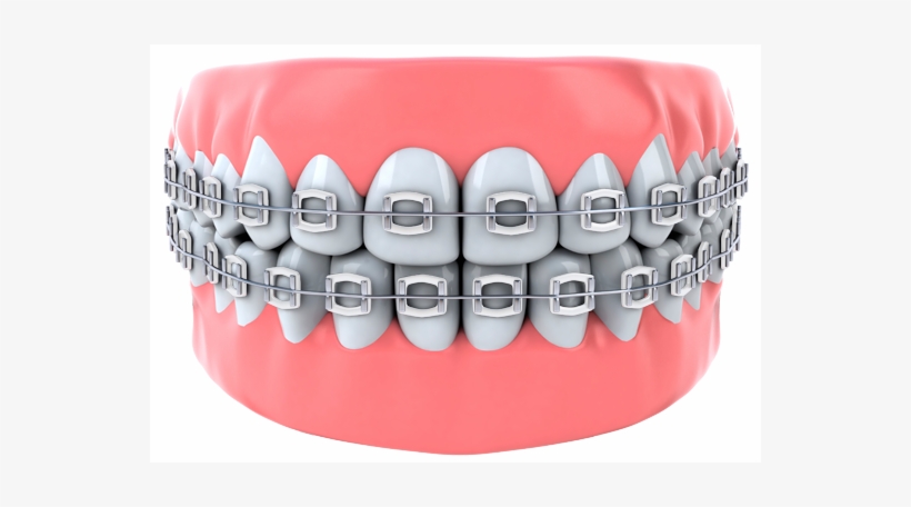 Teeth - Smoke Braces Color, transparent png