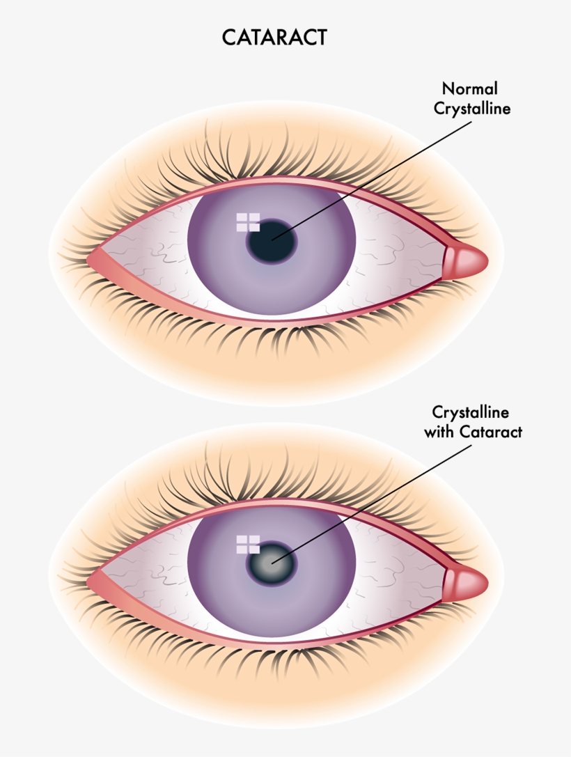 Cataracts Are A Clouding Of The Normally Clear Crystalline - Redness Of Conjunctiva, transparent png
