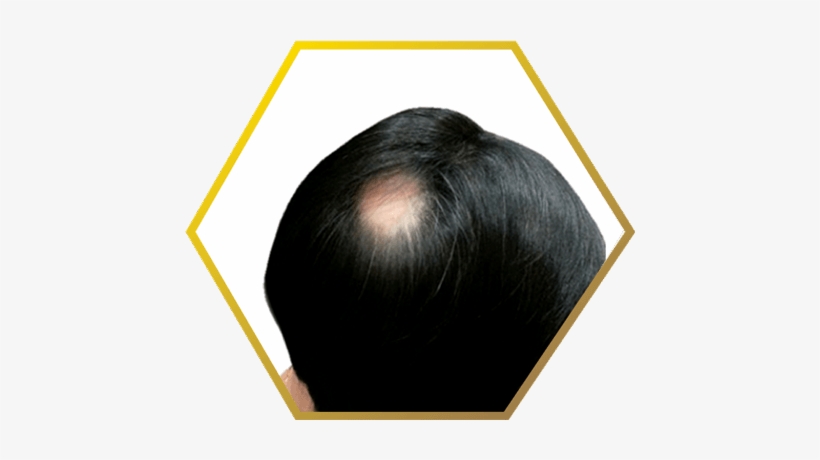 Jonsson Protein Male Bald Spot - Jonsson Protein, transparent png