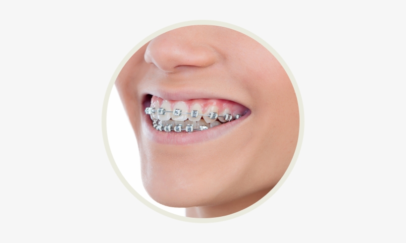 Color My Braces - Color Of Braces, transparent png