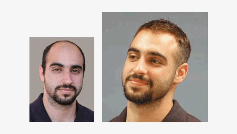Men S Hair Replacement Systems Hair Piece Before And Mens Hair