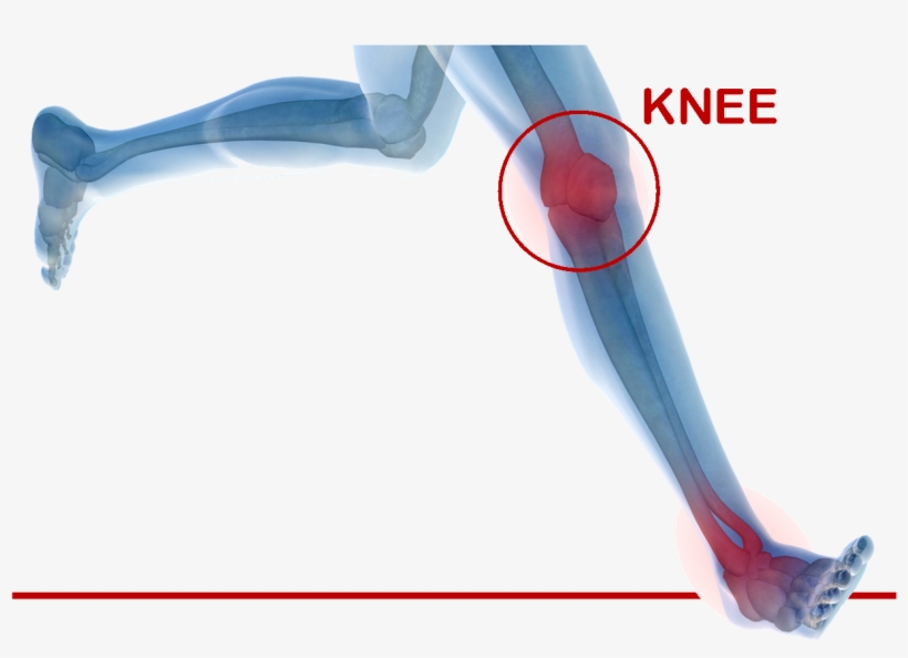 Kneeheader - Knee Replacement Png, transparent png
