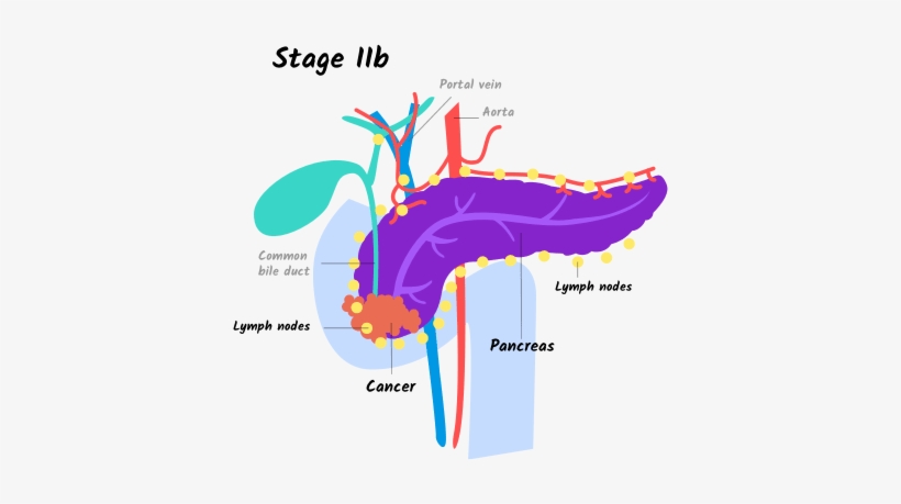 Illustration Of Stage Iib Pancreatic Cancer - Stage Iib Pancreatic Cancer, transparent png