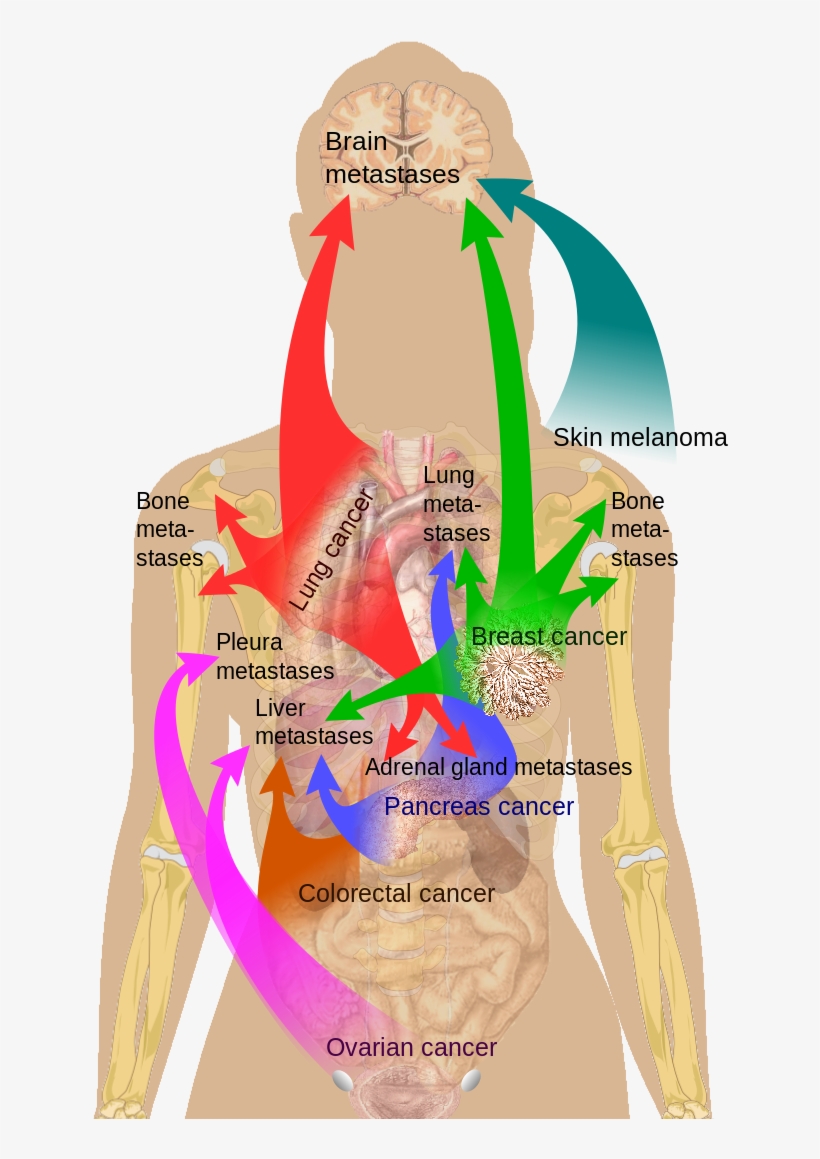 Click Here Or - Cancer Metastasis, transparent png