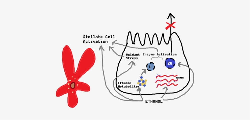 Hypothetical Development Of Alcoholic Pancreatitis - Alcohol And Pancreatitis, transparent png