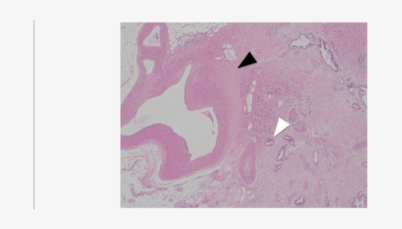 The Pathological Examination Revealed That The Tumor - Poster, transparent png