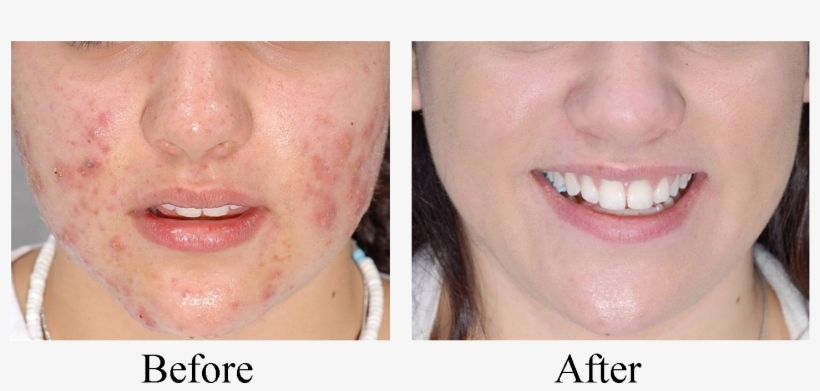 If You're Worried That Zit On Your Face Once You Wakened - Led Face Mask Before And After, transparent png