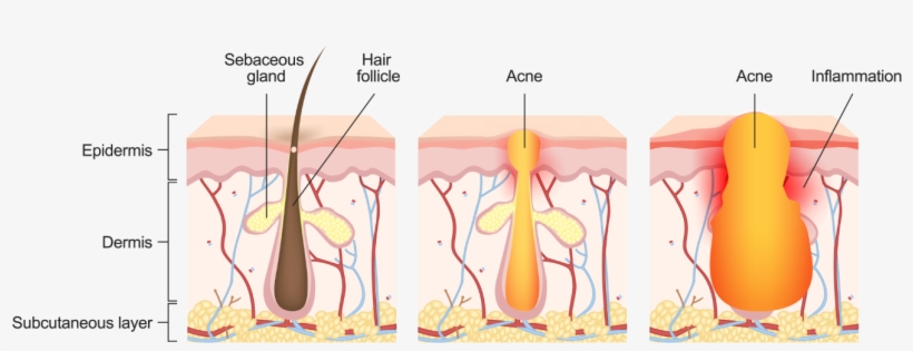 Acne Occurs When A Hair Follicle And Its Associated - Acne, transparent png