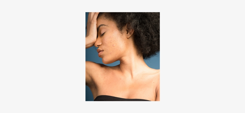 If You Suffer From Acne, You Know How Annoying It Is - Wrinkle, transparent png