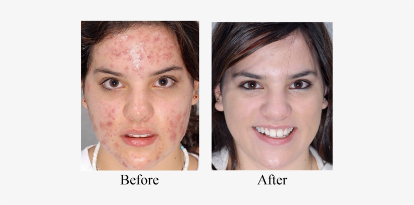 Download Acne Treatment Neutrogena Led Mask Before And After 500x347 Png Download Pngkit PSD Mockup Templates