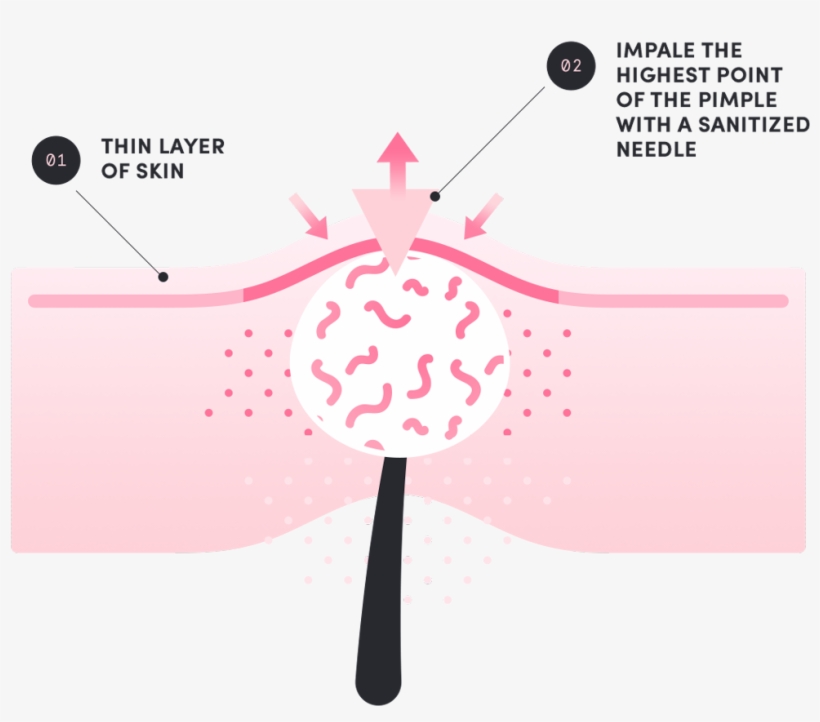 Death Of The Pimple - Pimple, transparent png