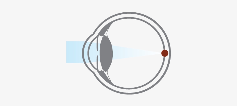 Presbyopia Is A Natural Aging Process That Usually - Circle, transparent png