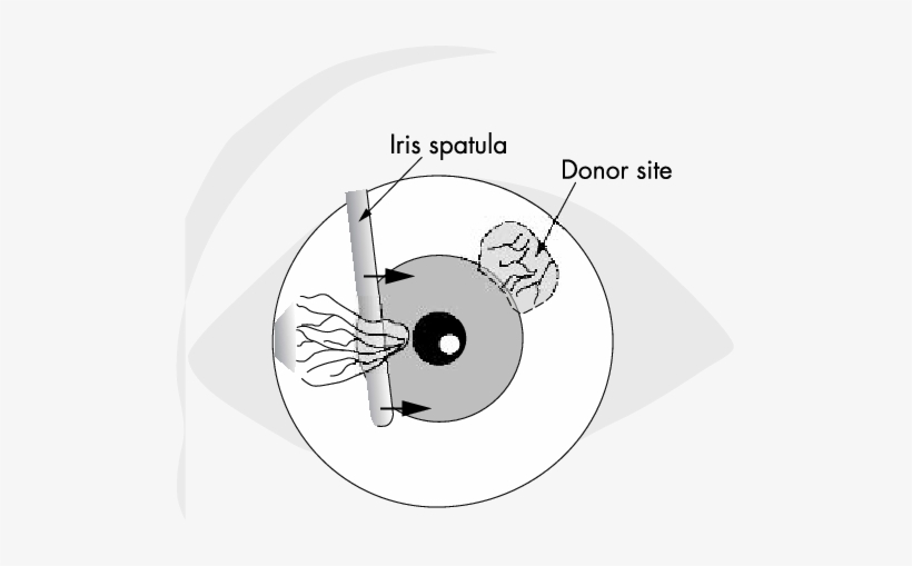 Blunt Dissection Of The Pterygium Head - Circle, transparent png
