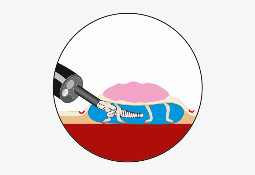 Preparation Of Submucosal Space Can Be Assisted By - Circle, transparent png