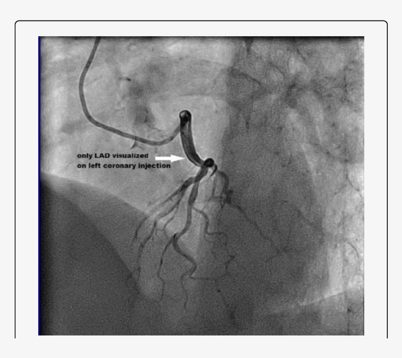 Lao Cranial View Reveals Only Lad On Left Coronary - Left Coronary Artery, transparent png