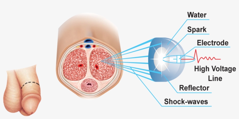 Canadian Pharmacy Survey Of The Latest Viagra Alternative - Peyroni Tedavisi, transparent png