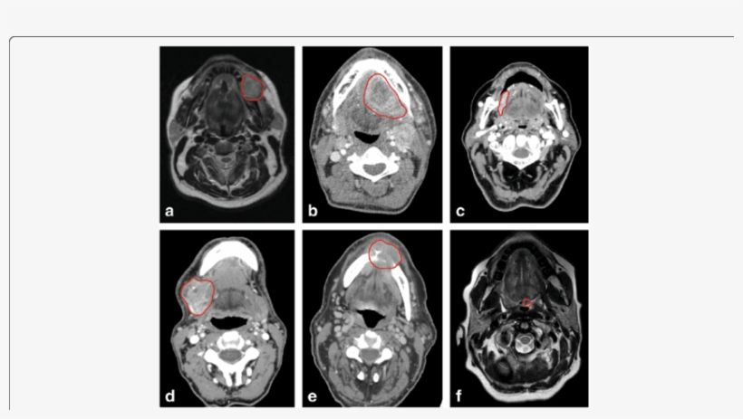 Primary Tumors Of Six Patients Encircled In Red - Neoplasm, transparent png