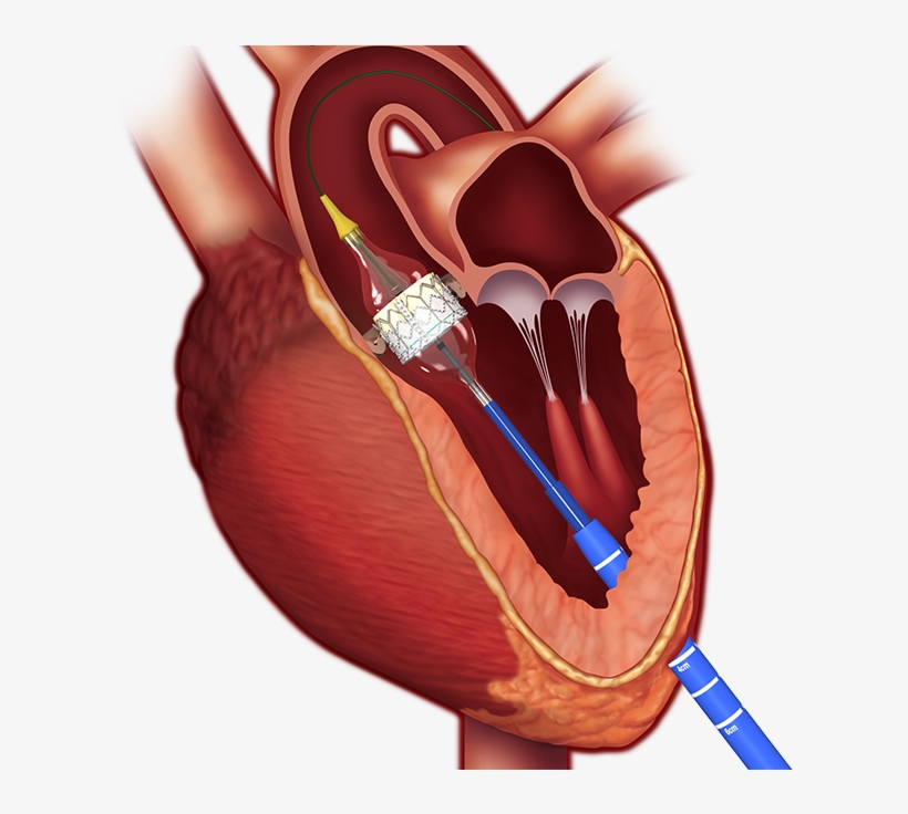 Current Team Members - Aortic Stenosis Treatment, transparent png