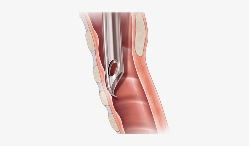 Flex-tip Endotracheal Tubes - Pediatrics, transparent png