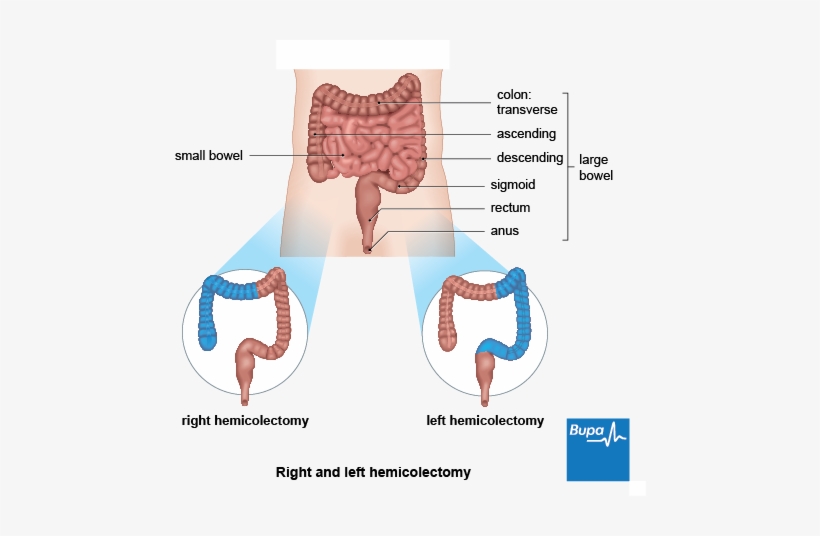 A Diagram Showing The Section Of Bowel Removed During - Right And Left Hemicolectomy, transparent png