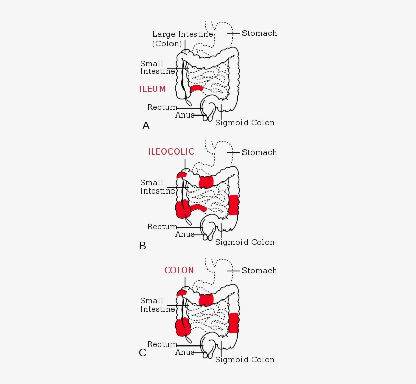 The Three Most Common Sites Of Intestinal Involvement - Chrome Disease, transparent png