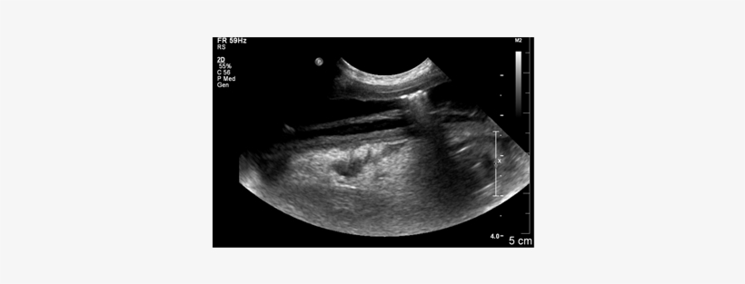Longitudinal Image Of The Affected Small Intestine - Ultrasound, transparent png
