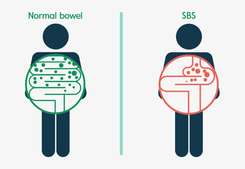 Whereas, Food And Liquid Remain In A Normal Bowel For - Short Bowel Syndrome, transparent png