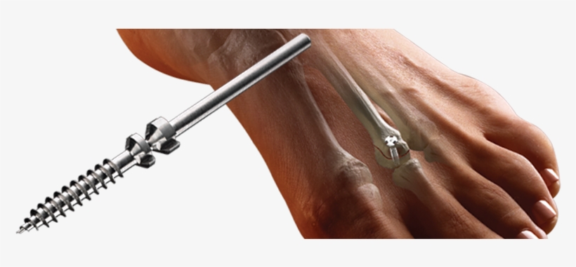 Charlotte™ Snap-off Screws - Twist Off Screw, transparent png