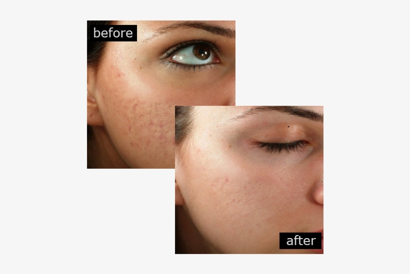 Acne Scar Removal With Outstanding Results - Philings Before And After, transparent png