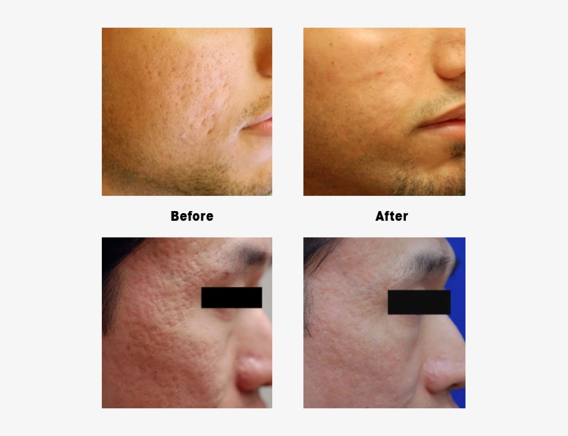 Acne Scarring Before & After Photos - Liquid Nitrogen Facial Scar, transparent png